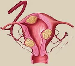 卵巢囊腫能做試管嬰兒嗎