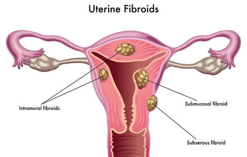 子宮肌瘤不用管 出現這4種情況,需另當別論