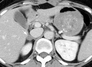雙側腎上腺皮質增生怎么辦 原因 檢查 診斷 內科 腎內科 癥狀查詢 尋醫問藥網