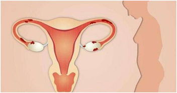 女人最怕卵巢早衰 做到這五點,打響卵巢保衛戰