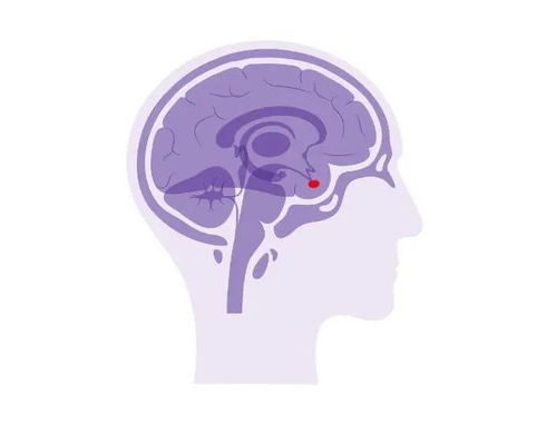 突然變胖變丑視力下降？警惕垂體瘤影響生殖激素