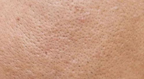 應對大面積毛孔粗大 本色膚雕與生殖激素的皮膚管理